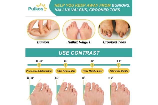 Puikos Bunion Corrector for Women Men Big Toe Brace Bunion Splint Big Toe Straightener Bunion